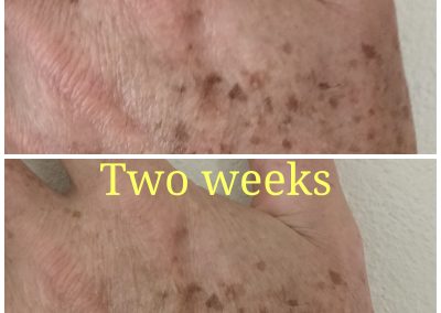 Youth lightens blemishes - Wound Warrior