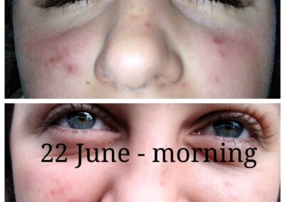 Acne - Wound Warrior