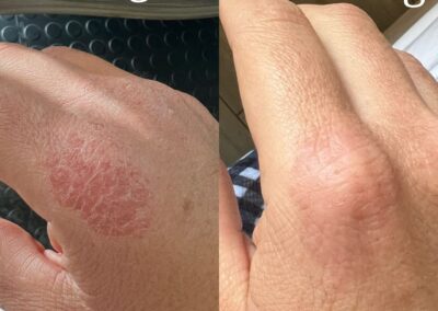 Eczema - Wound Warrior
