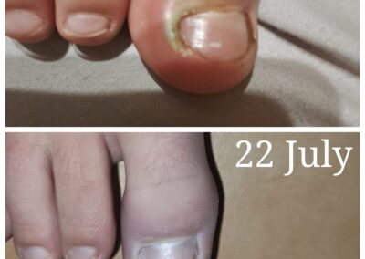 Torn Cuticle - Wound Warrior