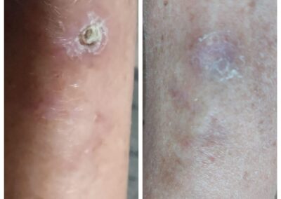 Diabetic wound – Wound Warrior